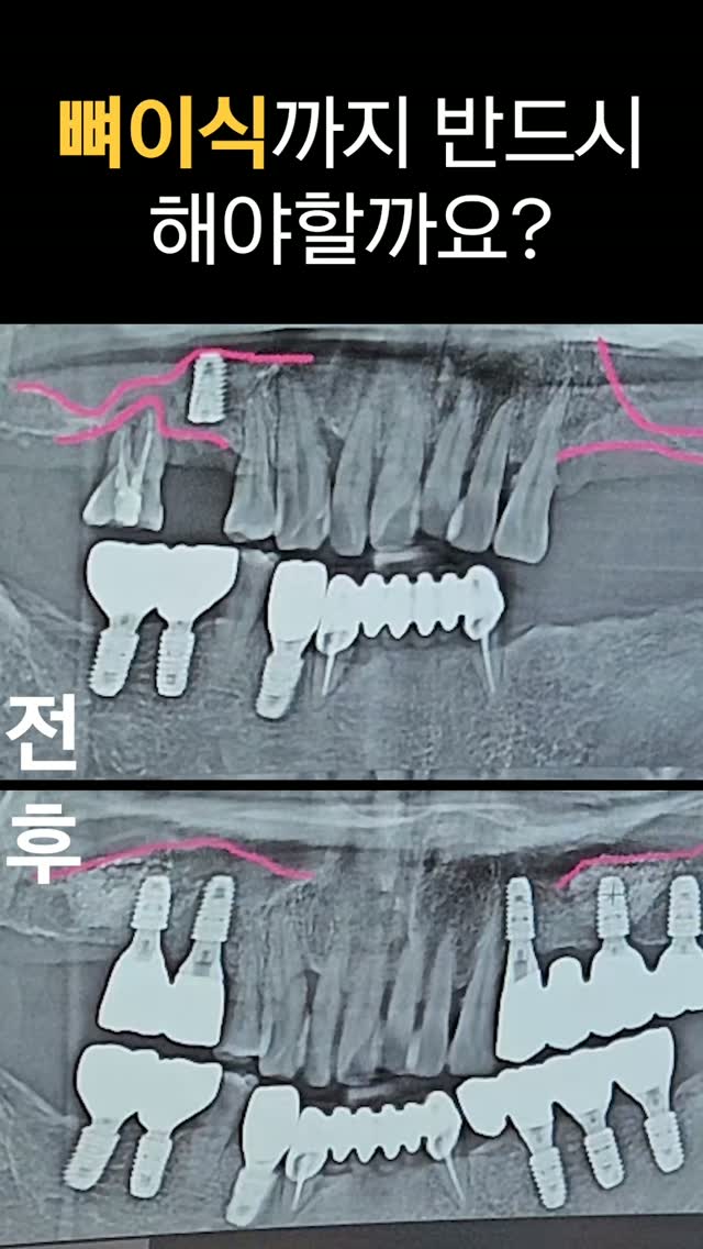 뼈이식까지 하자고 하면, 꼭 해야 할까요?