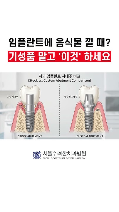 임플란트에 음식물 낄 때 기성품 말고 이것 하세요
